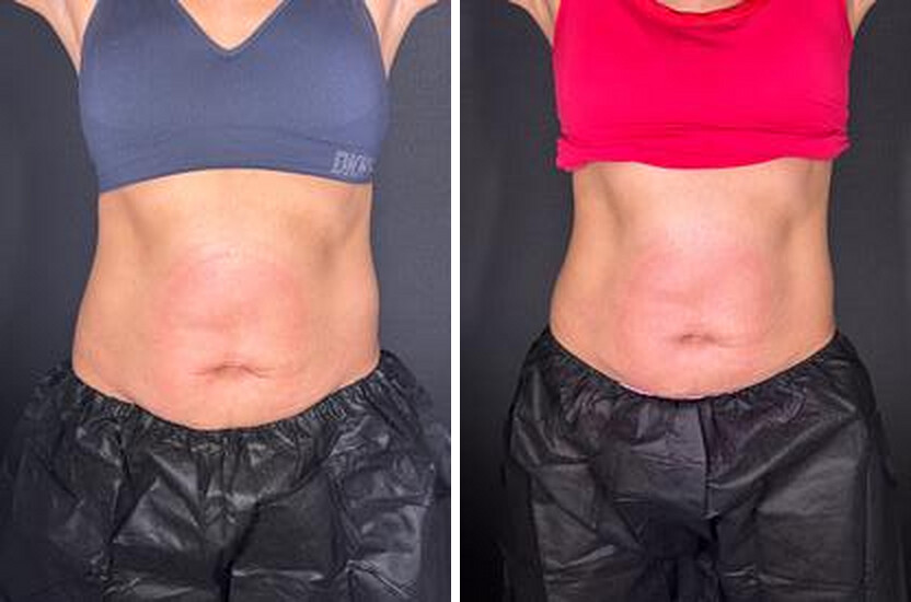 Before and after body contouring results, real Skin Lab patient; individual results vary