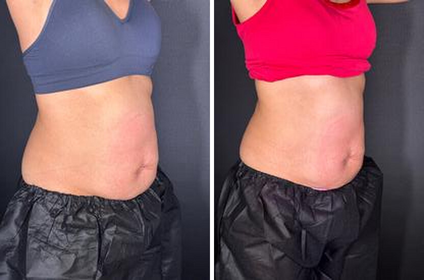 Before and after body contouring results, real Skin Lab patient; individual results vary