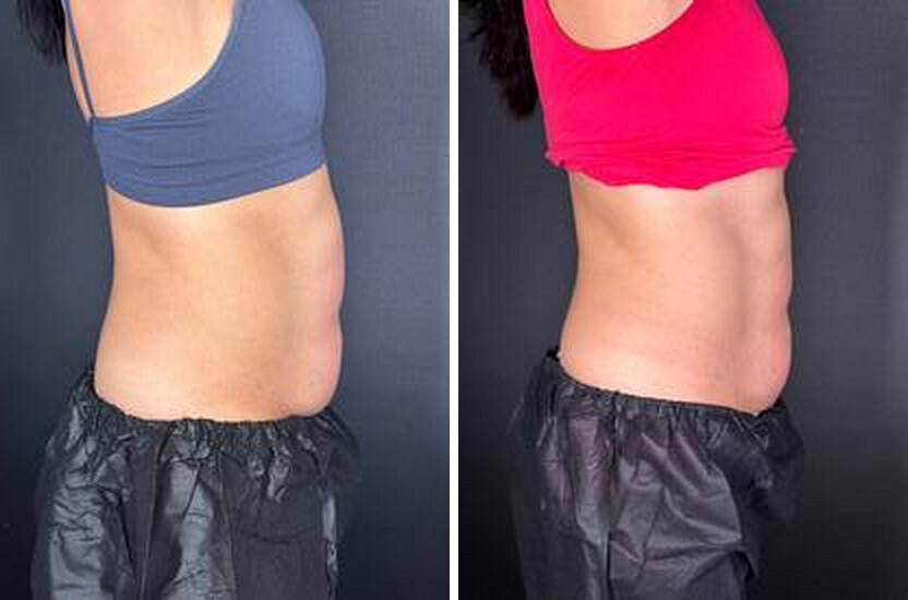 Before and after body contouring results, real Skin Lab patient; individual results vary