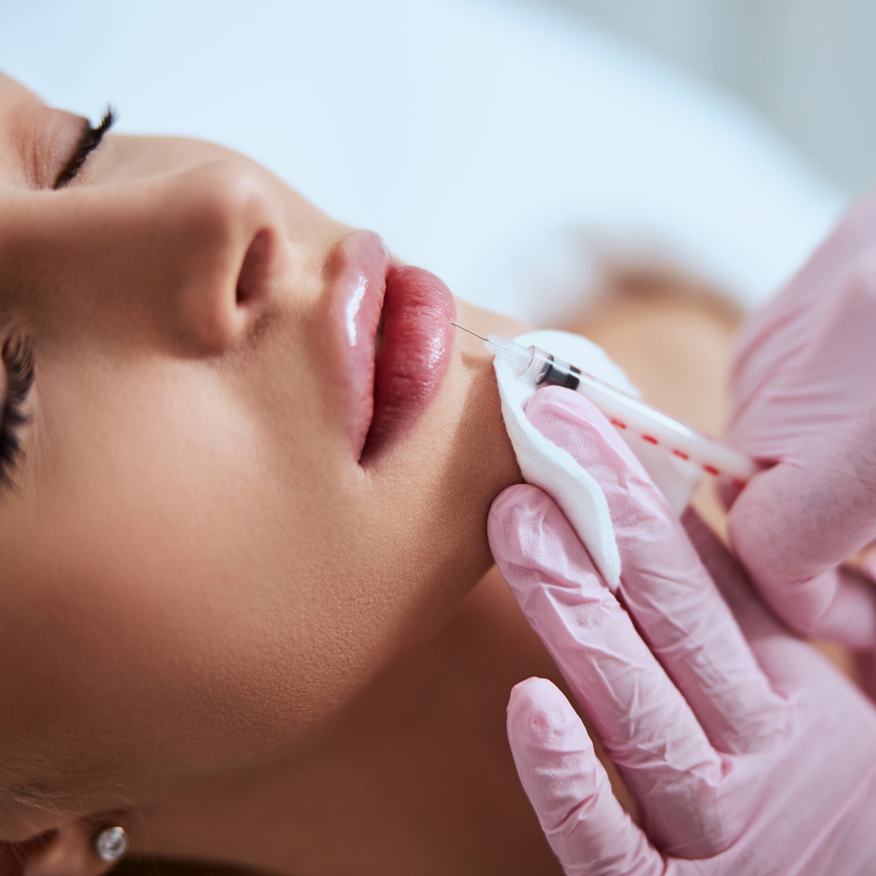 Lip filler results at Skin Lab Med Spa in Falls Church, VA