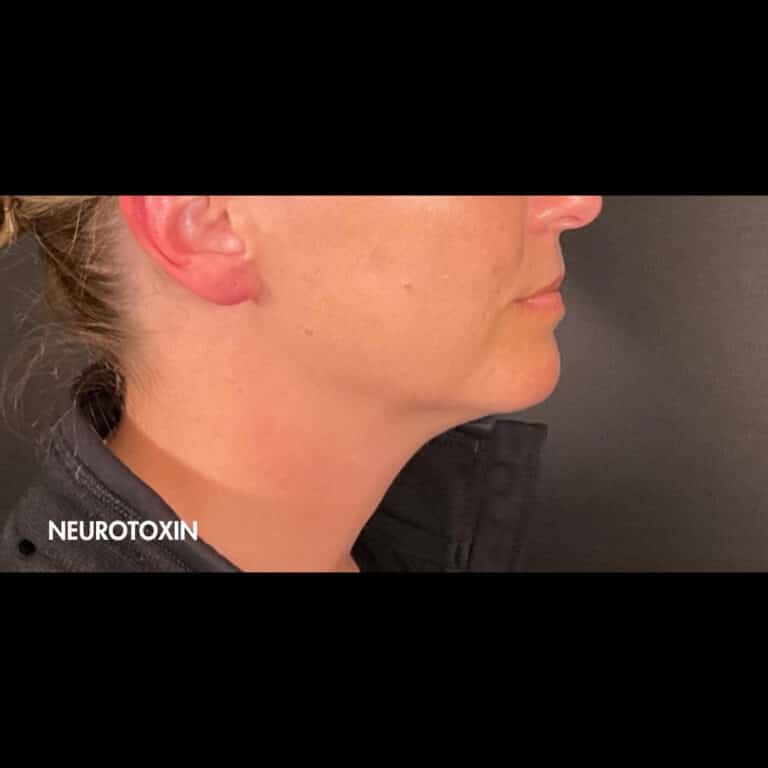 Neurotoxin - Skin Lab Med Spa